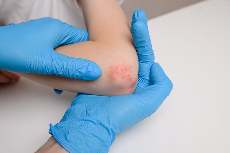 Dermatología Pediátrica